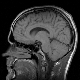 » Two Types of Sleep Apnea: Obstructive and Central