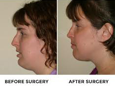 jaw-surgery-before-after-pictures