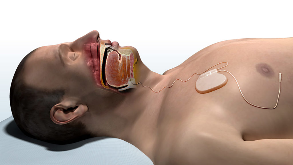 Inspire Normal Breathing with Inspire Original Image