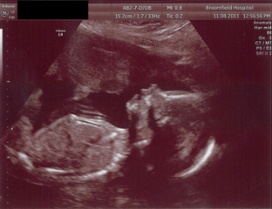 Pregnancy Scan Image